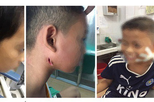 Phát hiện 3 trẻ bị nhiễm "vi khuẩn ăn thịt người" ở Nghệ An