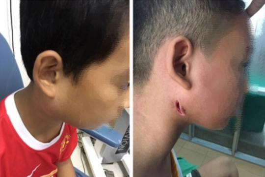 Điều trị thành công cho một trẻ em bị mắc chứng bệnh Whitmore