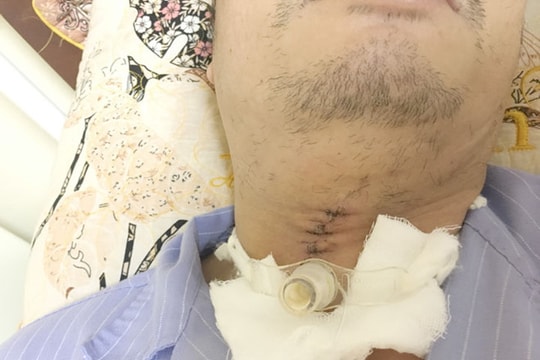 Cấp cứu kịp thời người đàn ông bị đá mài bắn vào cổ