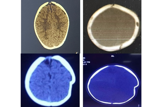 Hộp sọ bé gái 8 tháng tuổi bị lún sâu vì ngã xe tập đi