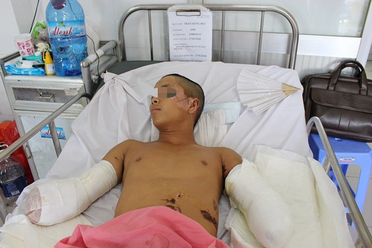 Tài xế bị cắt bỏ 2 cánh tay vì điện giật khi bắt chim trên trụ điện