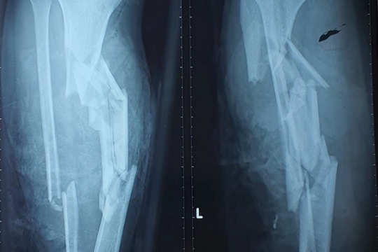 Hãi hùng với hình ảnh hai chân gãy nát vì bị chân vịt ca nô chém