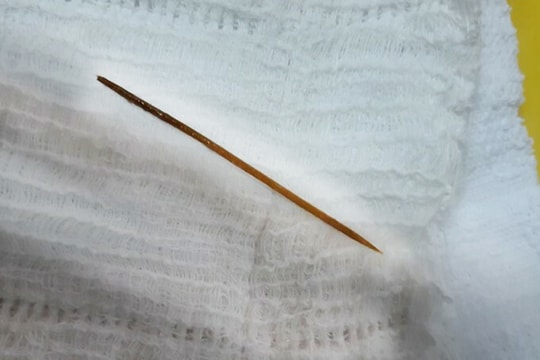 Gắp que tăm dài 6cm nằm trong ruột non của người đàn ông