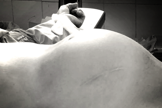 Cụ bà U70 mang khối u buồng trứng nặng 3,7kg