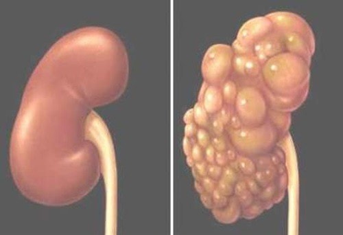 Phẫu thuật thành công cho bé trai 4 tuổi bị bệnh thận đa nang