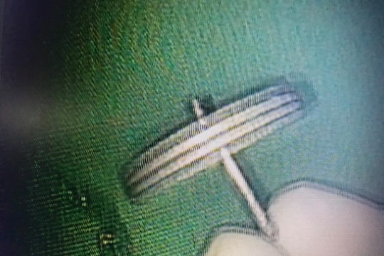 Bé trai 4 tuổi nguy kịch vì nuốt phải bánh xe đồ chơi