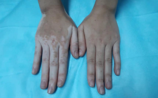 Cô gái bỗng nhiên đổi màu tay chân vì chữa ra mồ hôi bằng lá trầu không