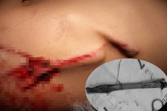 Vấp ngã khi chơi, bé 8 tuổi bị gốc cỏ voi đâm thủng bụng