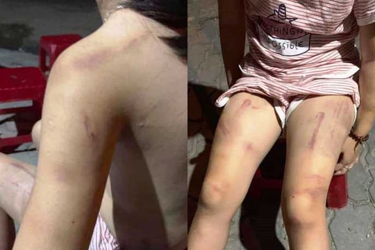 Bé gái 6 tuổi bị cụ nội dùng gậy đánh bầm tím khắp cơ thể