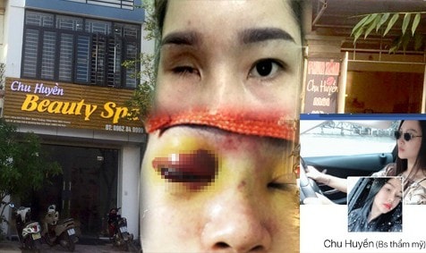 Nâng mũi tại cơ sở làm đẹp, cô gái trẻ bị mù mắt vĩnh viễn