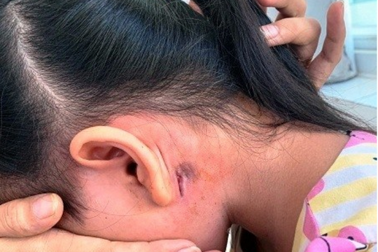 Thêm một bệnh nhi 5 tuổi mắc bệnh Whitmore