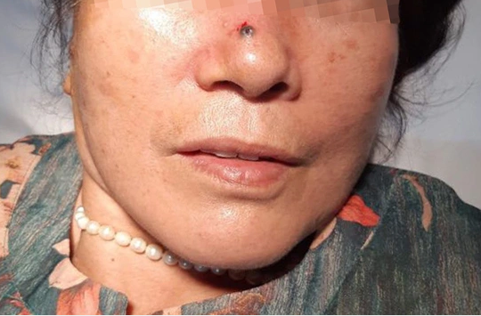 Nốt ruồi tưởng vô hại trên mũi lại hóa ung thư da