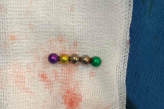 Nuốt nam châm đồ chơi, bé gái 1 tuổi bị thủng ruột