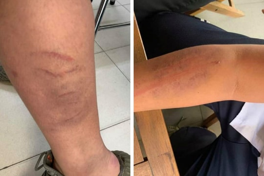 Bé trai lớp 7 ở Hà Nội tố bị bố đẻ đánh dã man vì viết chữ xấu