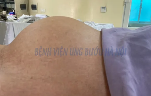 Phẫu thuật thành công cho cụ bà 81 tuổi mang khối u buồng trứng khổng lồ