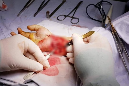 Ngã trúng viên gạch vỡ, bé trai 6 tuổi đứt gần lìa bàn tay