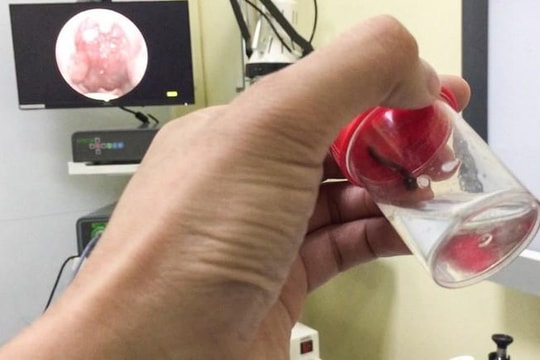 Kinh hãi con vắt ngọ nguậy trong mũi nam thanh niên sau chuyến đi phượt