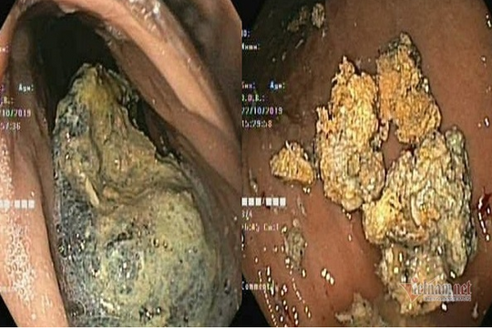 Người phụ nữ suýt mất mạng vì ăn quả hồng giòn