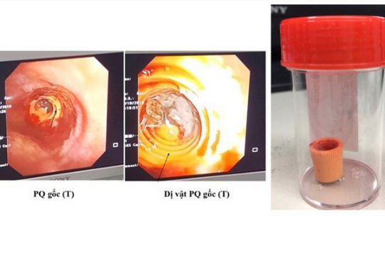 Suýt mất mạng vì nắp tuýp thuốc bít tắc phế quản