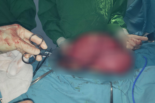 Cứu chữa thành công người phụ nữ mang khối u 6kg