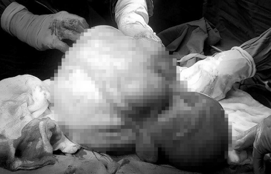 5 giờ căng thẳng lấy khối u xơ tử cung nặng 6,3 kg