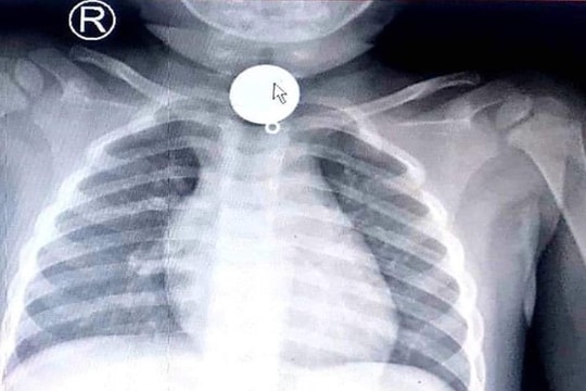 Bé trai 2 tuổi tắc ống thực quản vì nuốt mặt dây chuyền