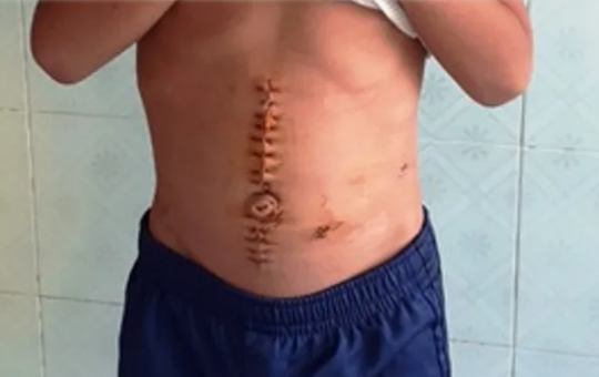 Cứu sống bé trai 6 tuổi bị súng tự chế bắn thấu bụng
