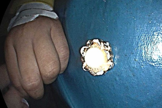 Gắp thành công dị vật kim loại trong thực quản bé trai 4 tuổi