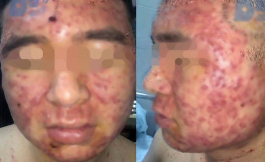 Gương mặt nam thanh niên chi chít mụn sau khi dùng thuốc mua trên mạng