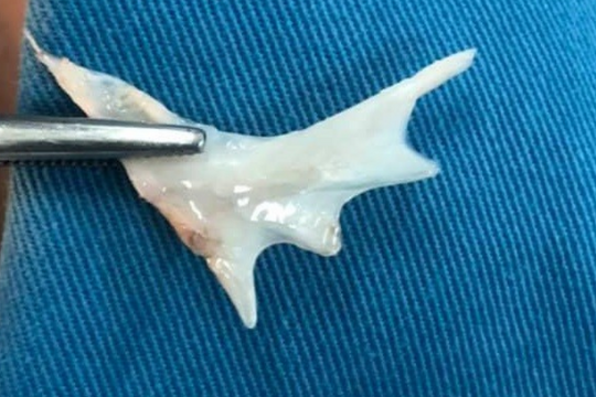 Gắp thành công xương cá “khủng” trong thực quản bệnh nhi