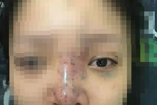 Hai phụ nữ mù mắt sau khi tiêm chất làm đầy