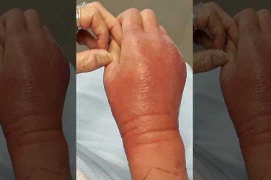 Người phụ nữ bị sốc nhiễm trùng, suýt mất mạng do mèo cào