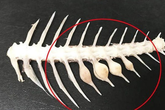 Người phụ nữ suýt mất mạng do xương cá nhọn đâm vào ổ bụng