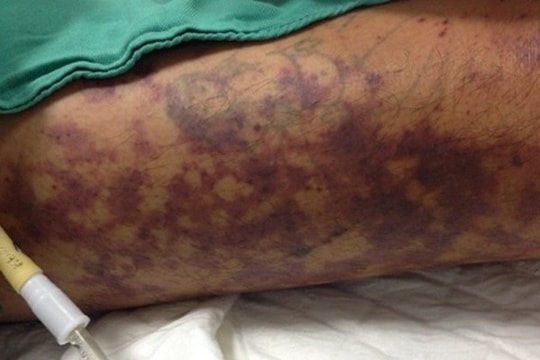 Người bán thịt lợn suýt mất mạng do nhiễm liên cầu khuẩn