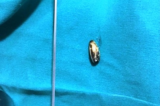 Bé trai 17 tháng tuổi suýt mất mạng vì hóc hạt hướng dương