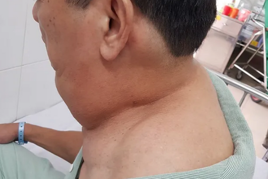 Uống 1 lít rượu mỗi ngày, người đàn ông phát hoảng vì chiếc cổ kỳ dị