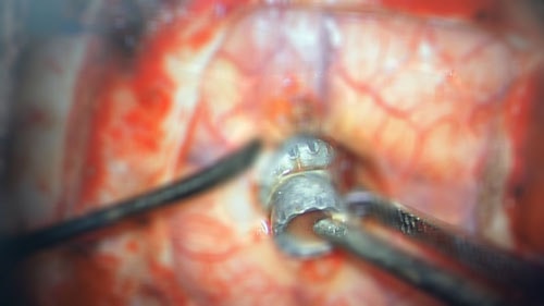 Gắp đạn súng hơi bắn xuyên từ ổ mắt vào trong sọ