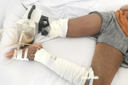 Nhờ thầy lang trị rắn cắn, bé gái 13 tuổi phải cắt bỏ chân