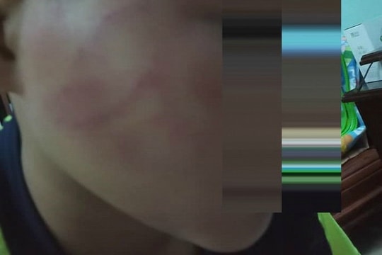 Không ngủ trưa, học sinh bị thầy giáo đánh bầm tím mặt