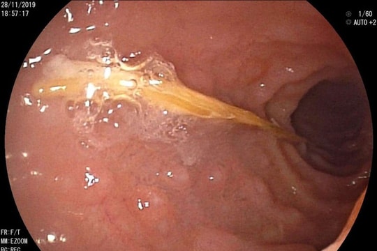 Bé gái nuốt tăm dài 5cm suýt thủng ruột