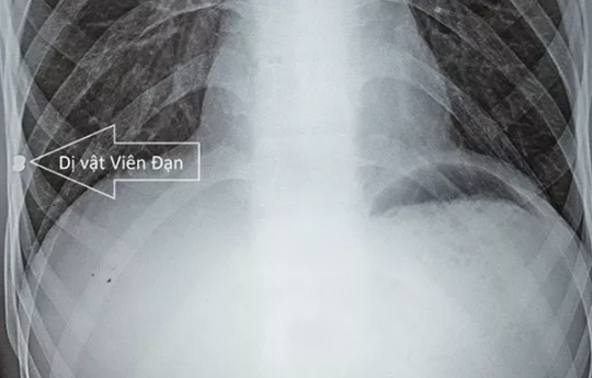 Lấy viên đạn trốn" trong lồng ngực nam bệnh nhân hơn 20 năm