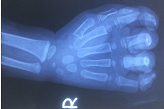 Bé trai 23 tháng tuổi dập nát cả bàn tay do bị cuốn vào máy rửa xe