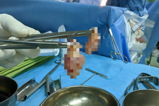 Cứu sống cụ bà 80 tuổi bị u tim có nguy cơ đột tử bất cứ lúc nào