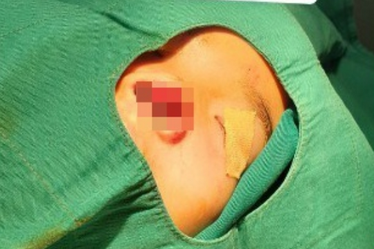 Ghép lại mảnh tổn thương mũi bị đứt rời cho bé gái 5 tuổi