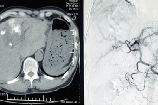Cứu sống bệnh nhân vỡ gan, máu ngập ổ bụng