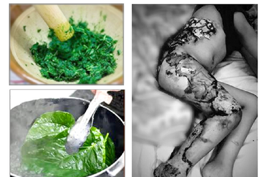 Bé trai tử vong thương tâm vì gia đình điều trị bỏng bằng… lá cây