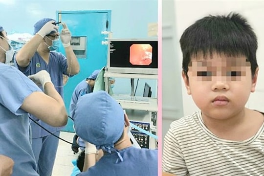 Bé 5 tuổi hóc xương gà, 2 năm sau mới được phát hiện