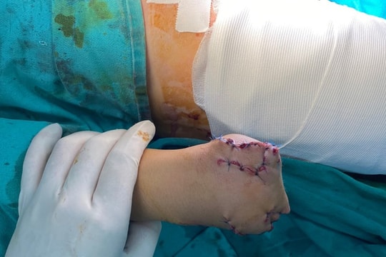 Học chế tạo pháo trên mạng, bé trai 13 tuổi bị cụt tay