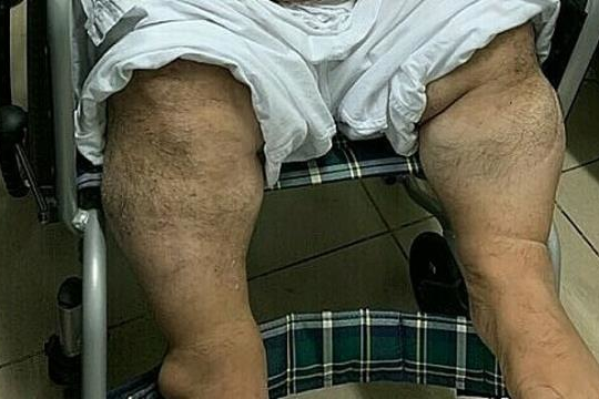 Việt Nam lần đầu sửa tim cho người lùn