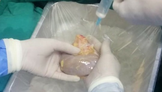 Bệnh viện tuyến tỉnh đầu tiên thực hiện ghép thận thành công từ người cho chết não